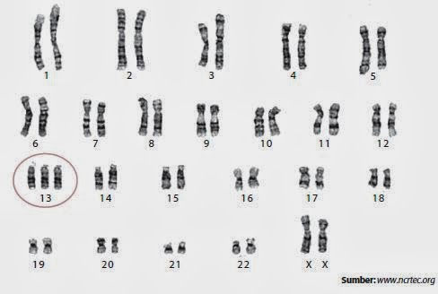 Macam-macam Sindrom yang disebabkan oleh Mutasi Kromosom | Biologi