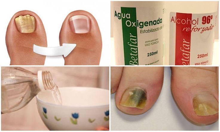 remedio para eliminar los hongos de las uñas