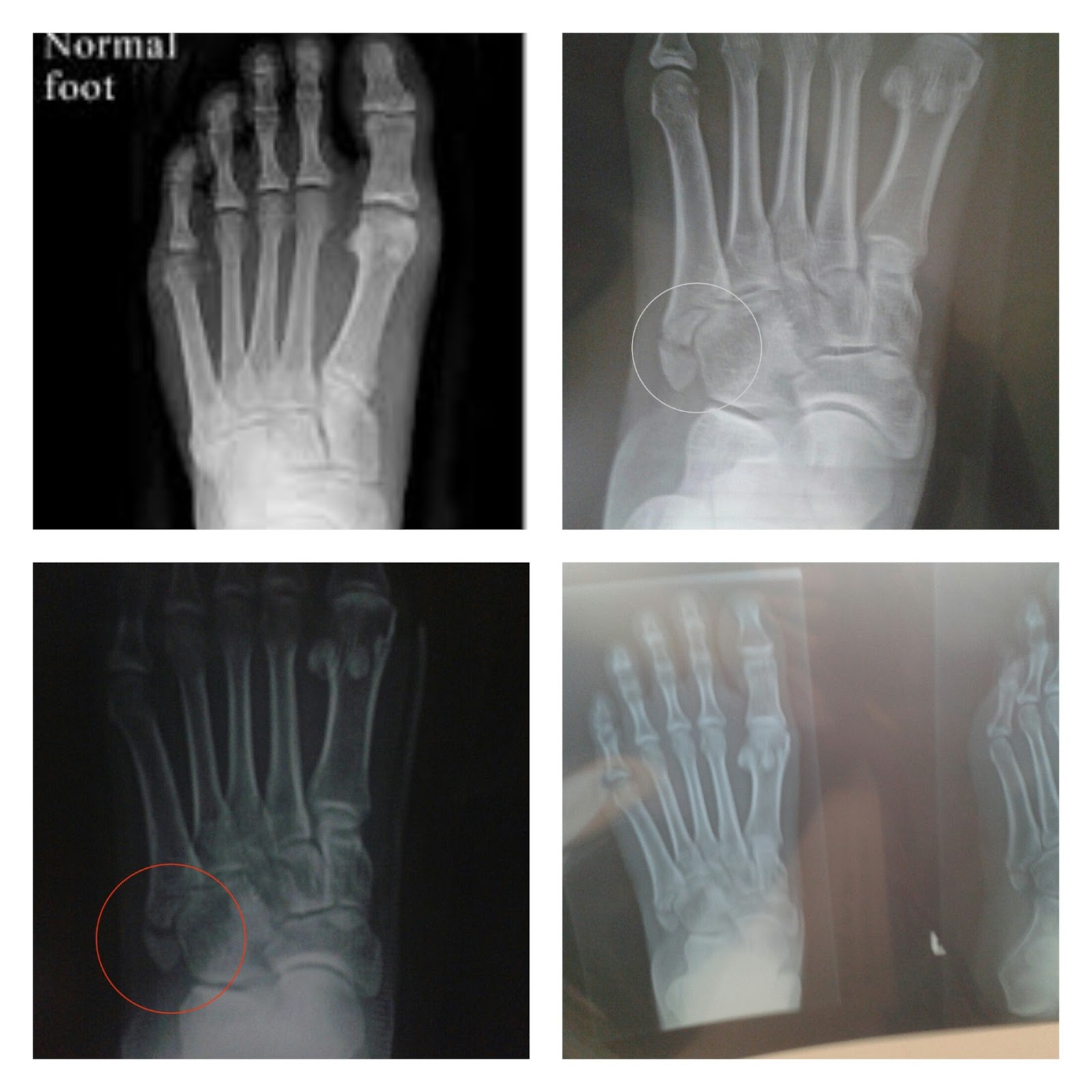 Family adikji: Patah kaki