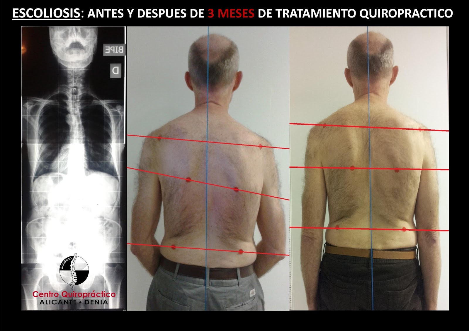 Remedios caseros para escoliosis lumbar