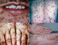 Apa Nama Obat Buat Penyakit Sipilis