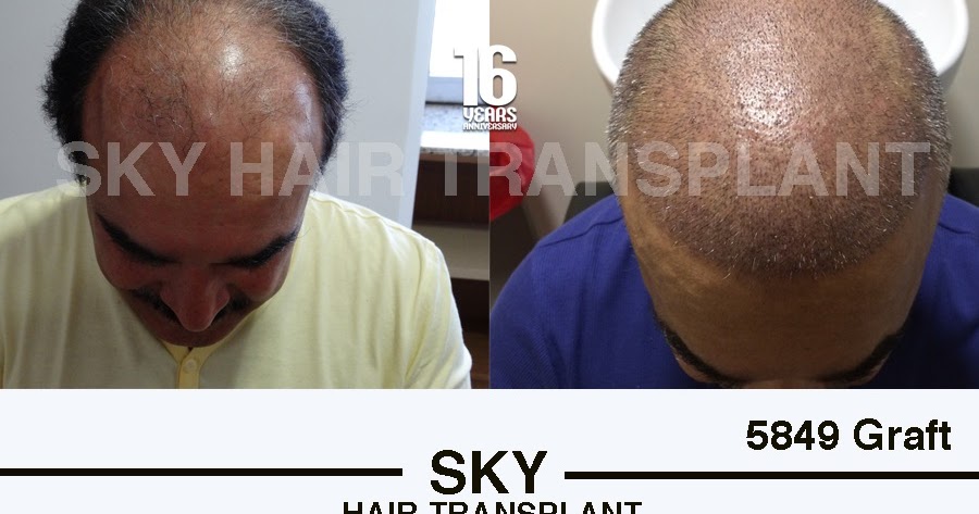 Forehead hair transplant in germany