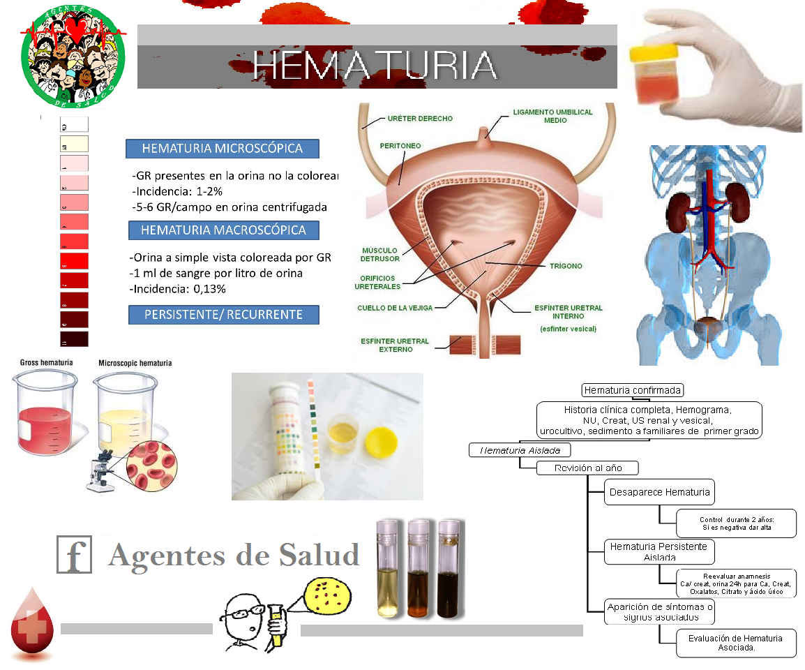 Agentes de Salud Hematuria