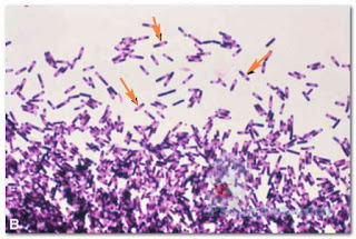 Continued. B. Gramstained Clostridium difficile bacteria, revealing subterminal spores (the light areas within the cells). C. difficile causes a diarrheal disease. (Courtesy of Dr. Gilda Jones and the CDC.) Continued. B. Gramstained Clostridium difficile bacteria, revealing subterminal spores (the light areas within the cells). C. difficile causes a diarrheal disease. (Courtesy of Dr. Gilda Jones and the CDC.)