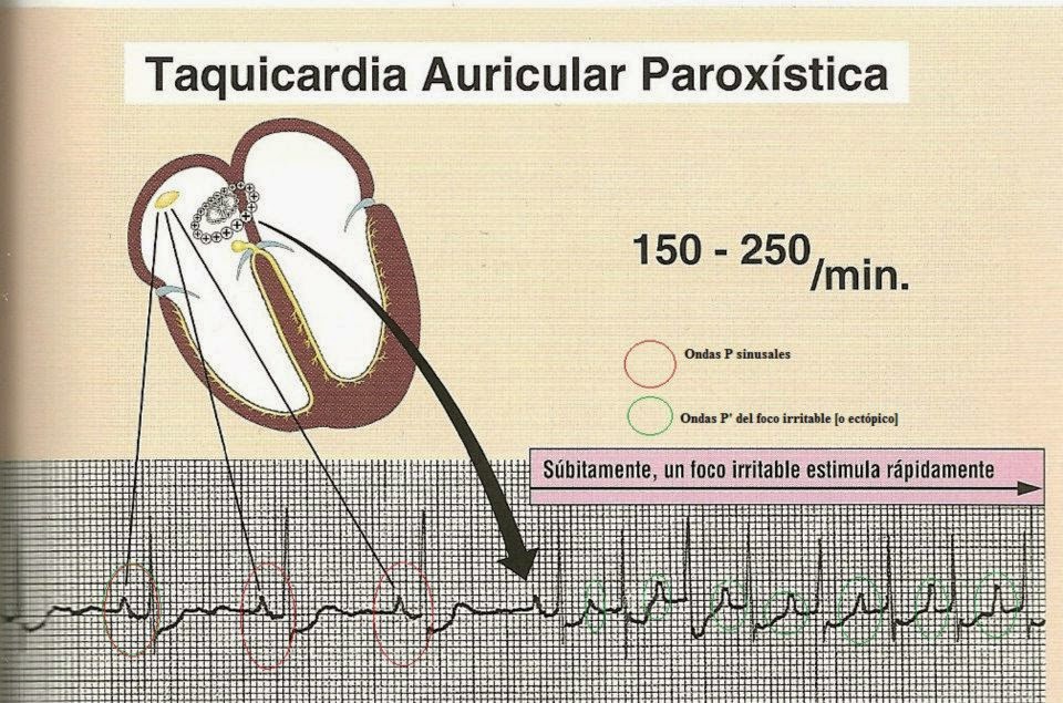 EPÓNIMOS: ENFERMEDAD DE BOUVERET