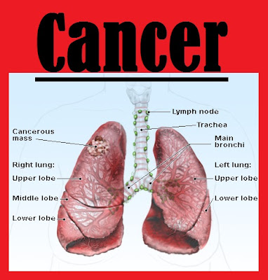 lung cancer survival rate | stage 4 lung cancer | lung cancer prognosis | lung cancer statistics | types of lung cancer | signs of lung cancer | lung cancer facts | stage 3 lung cancer | lung cancer diagnosis | what is lung cancer | lung cancer pictures | lung cancer photos | chemotherapy lung cancer | what causes lung cancer | metastatic lung cancer | non small cell lung cancer | lung cancer survival rate image | stage 4 lung cancer image | lung cancer prognosis image | lung cancer statistics image | types of lung cancer image | signs of lung cancer image | lung cancer facts image | stage 3 lung cancer image | lung cancer diagnosis image | what is lung cancer image | lung cancer pictures image | lung cancer photos image | chemotherapy lung cancer image | what causes lung cancer image | metastatic lung cancer image | non small cell lung cancer image | 