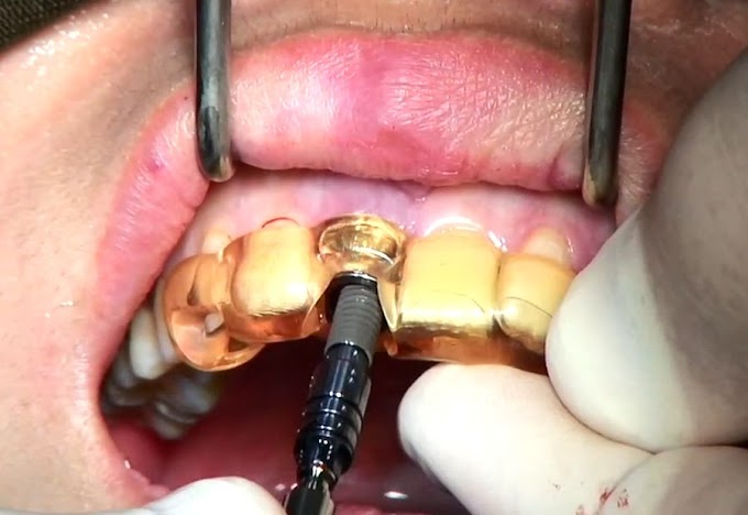IMPLANTOLOGY: Immediate Implants with Immediate Provisionals - Dreams and Reality