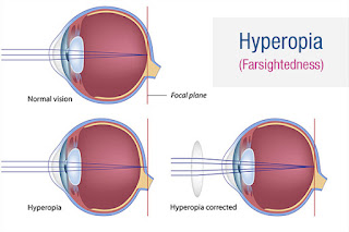 Hyperopia - will optical maser Eye Surgery Correct This Condition