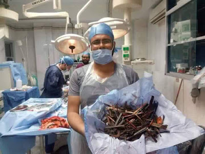  Doctors Remove Nails, Pens, Spoon From Stomach Of Woman With Medical Conditon Jolk
