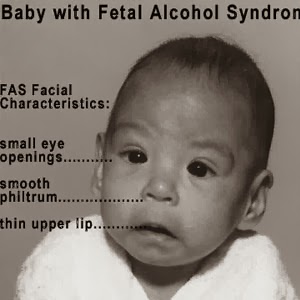 Medical Treatment Pictures-for Better Understanding: Fetal Alcohol Syndrome