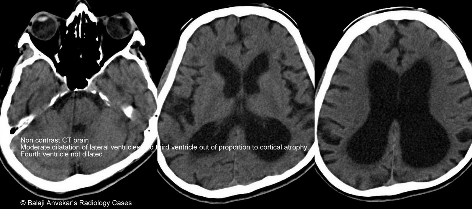 Dr Balaji Anvekar S Neuroradiology Cases Normal Pressure