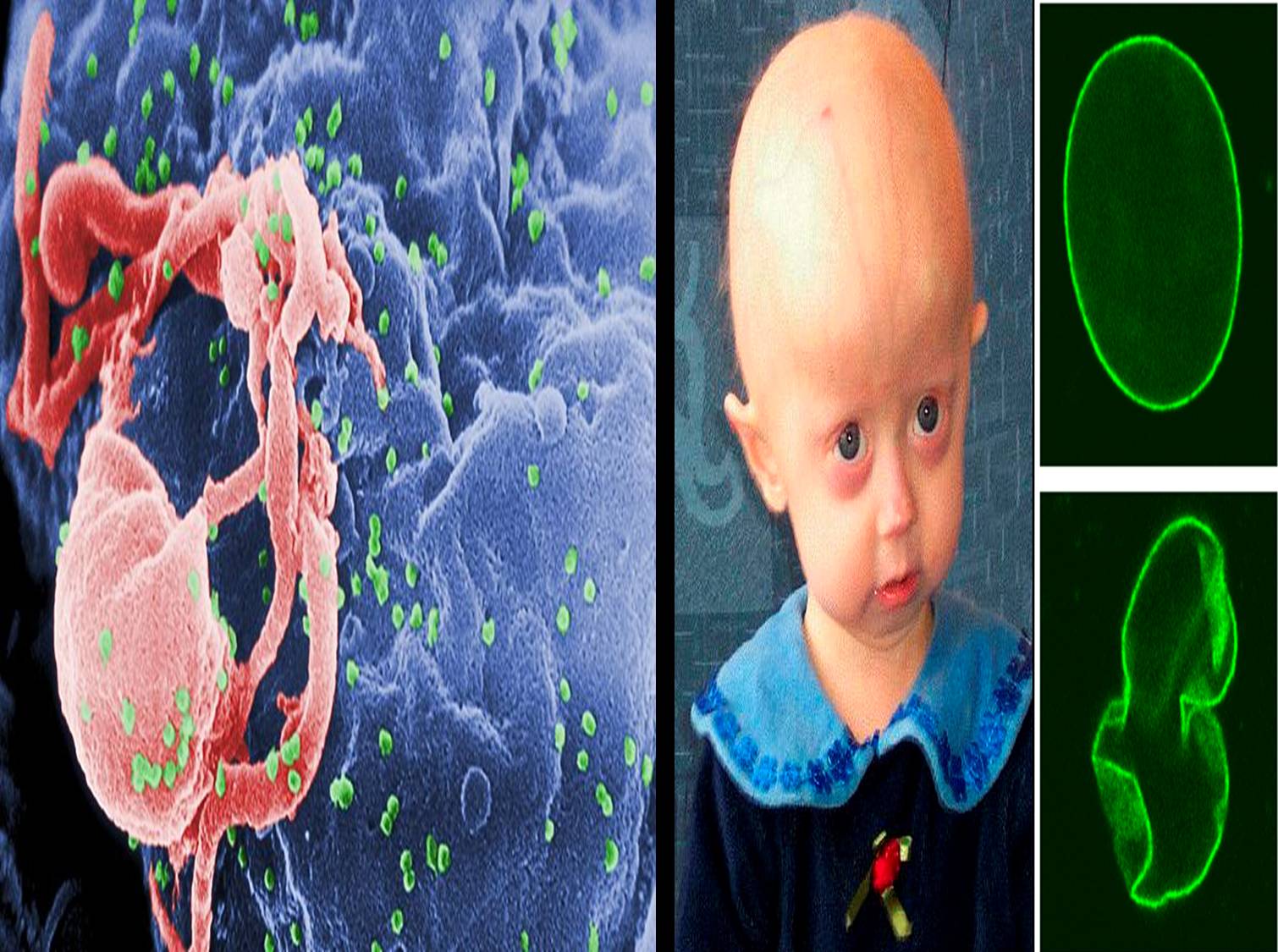 Oldest person with progeria disease image