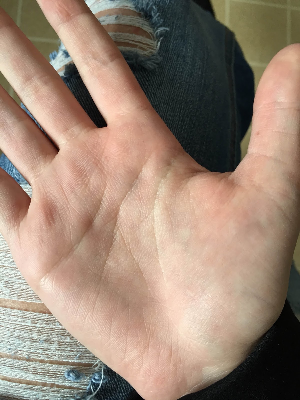 VIRTUAL GRAND ROUNDS IN DERMATOLOGY 2.0 Aquagenic Wrinkling of the Palms