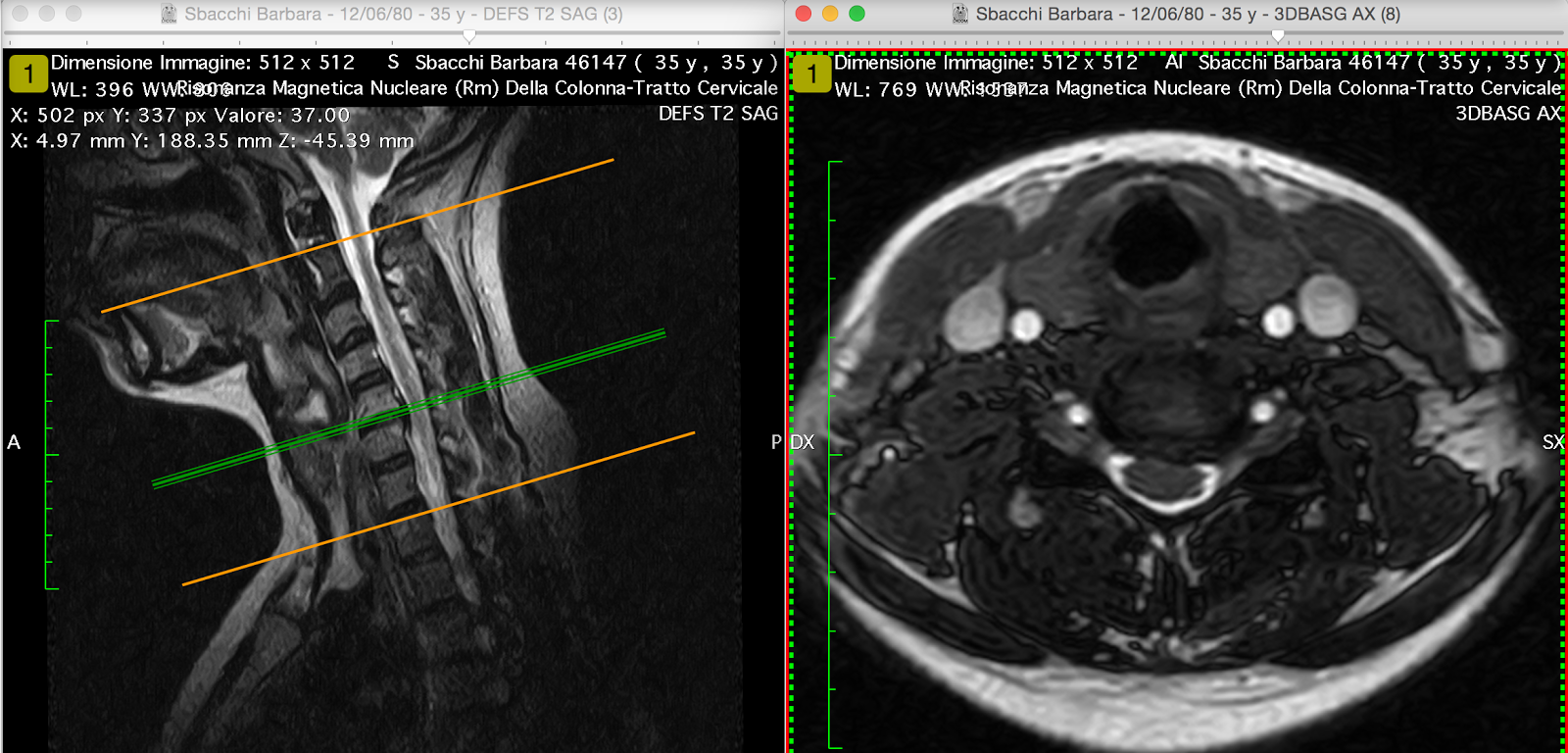 Trattamento di osteochondrosis in yoga