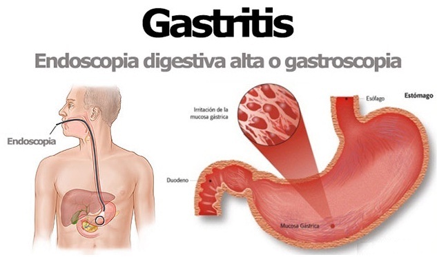 Buscapina para gastritis