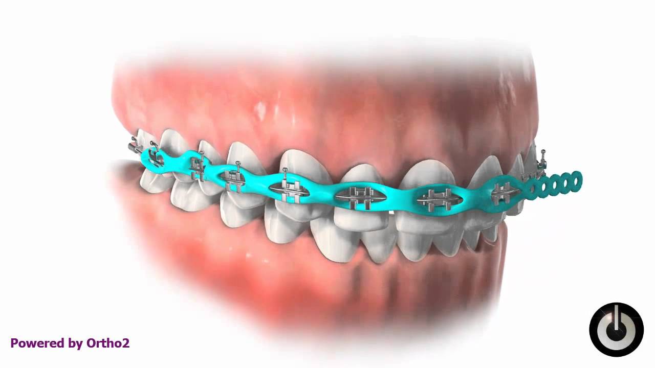Blog Sal Braces Journey Part 4 Lepas 40 Hari
