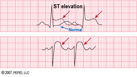 ST Elevasi Miokard Infark (STEMI) | Kalangkang Mencrang