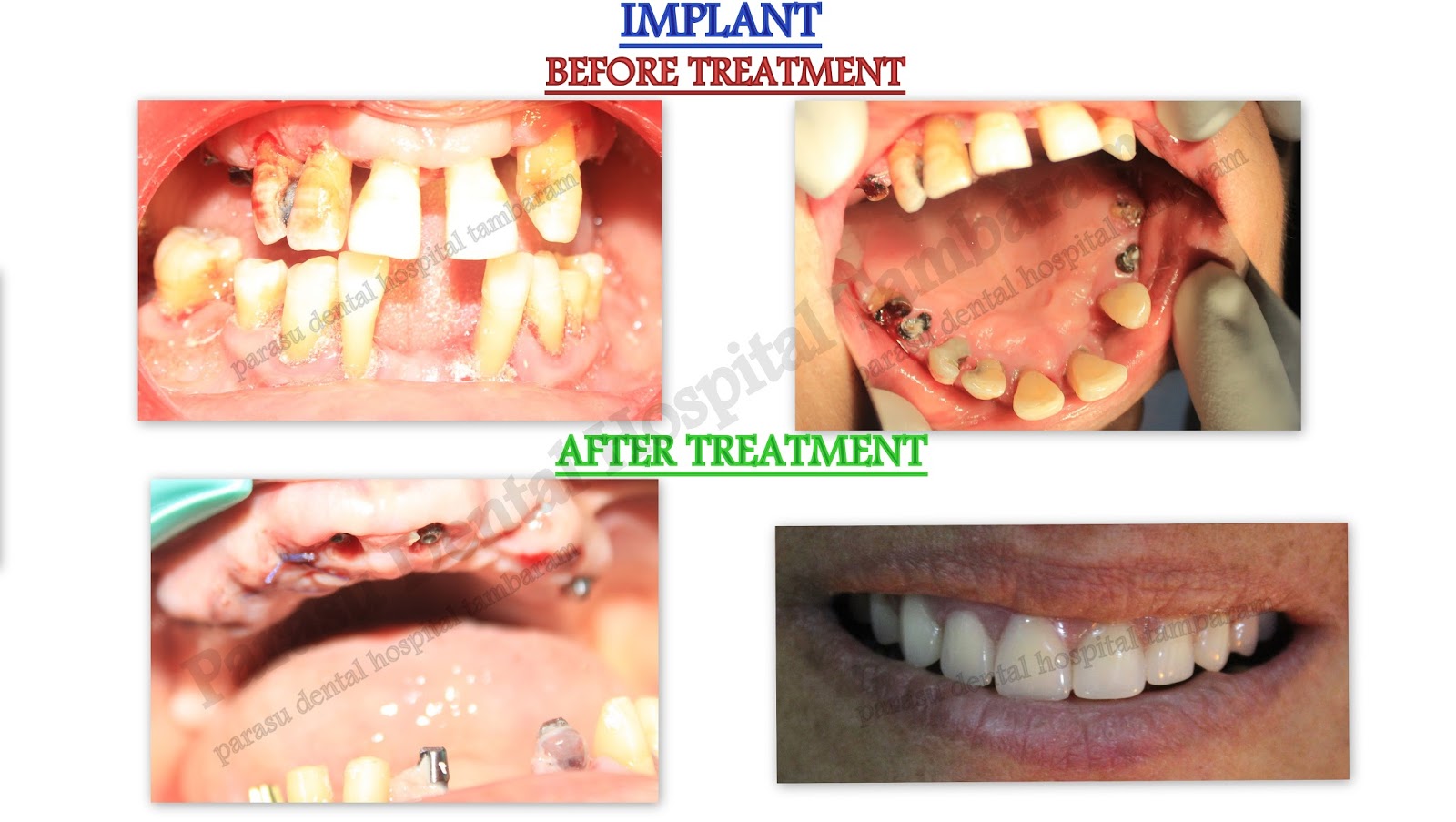 dental implants cost in chennai,India Best Dental Tourism in Chennai
