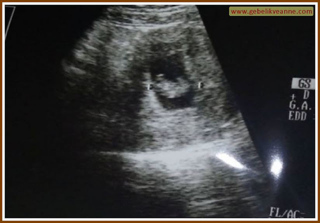 9 hafta 5 günlük bebek görüntüsü