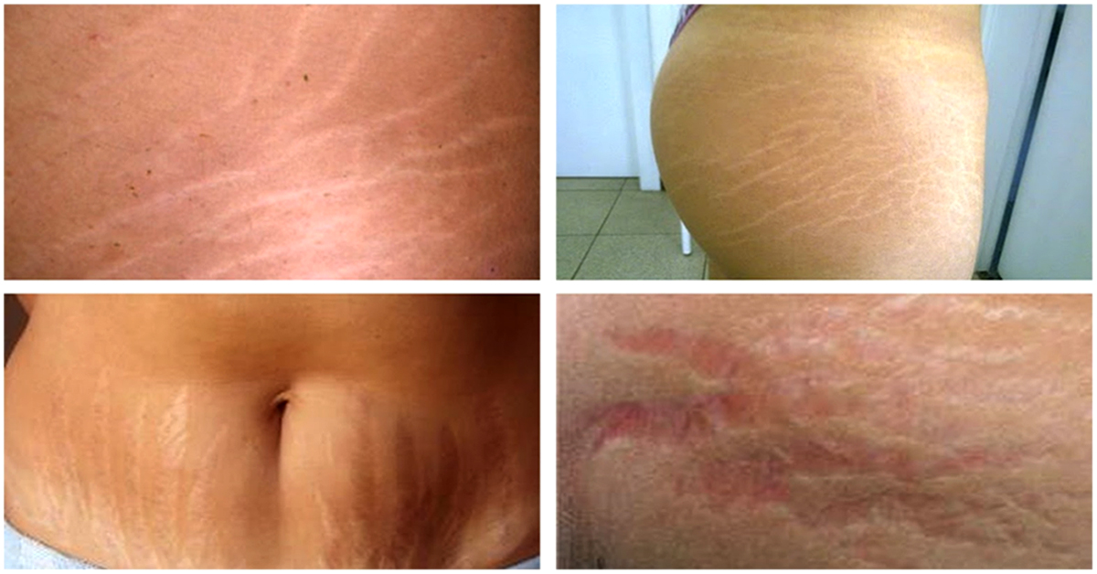 ¡Reduzca las Estrias Rojas de las Axilas!_3 Estrias rojas en axilas_3