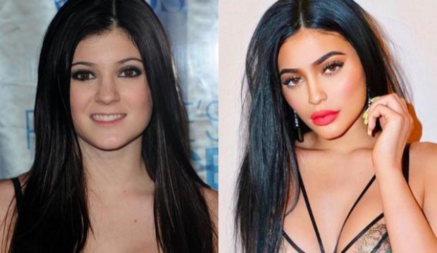 Kylie Jenner insiste en que no se ha operado el rostro