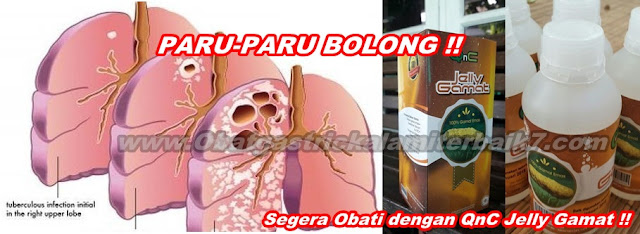 Cara Ampuh Menyembuhkan Paru-Paru Bolong Secara Total Cara Ampuh Menyembuhkan Paru-Paru Bolong Secara Total