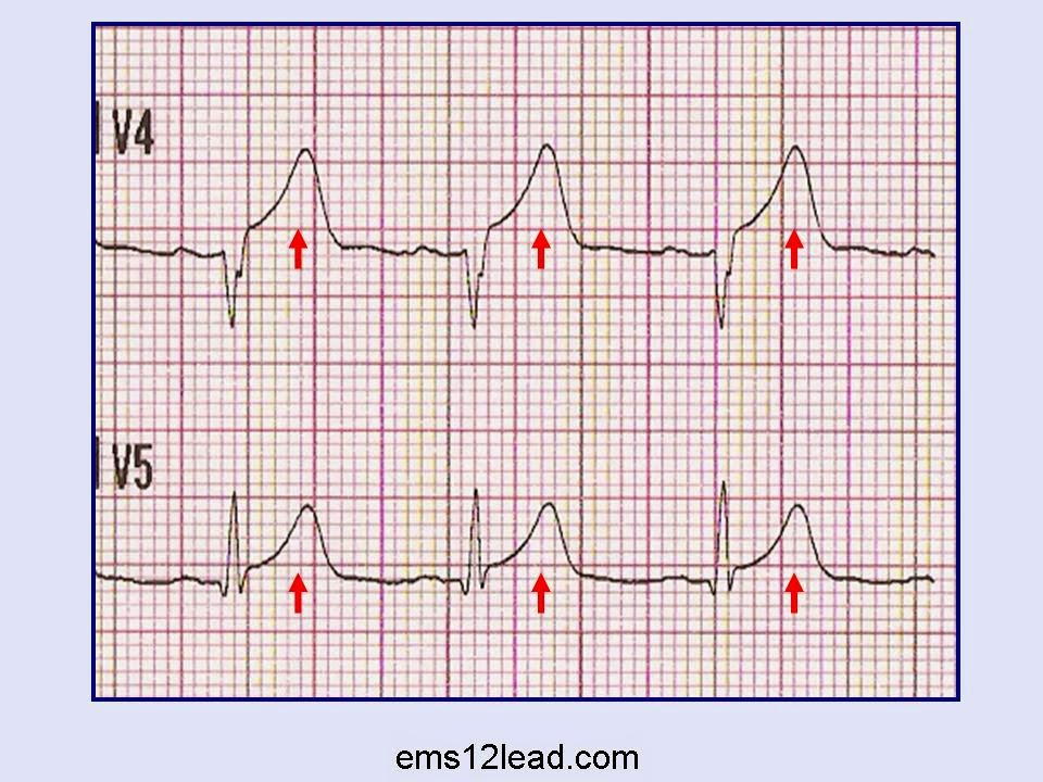 Enciclopédia de ECG Nomenclatura Onda T Enciclopédia de ECG Nomenclatura Onda T