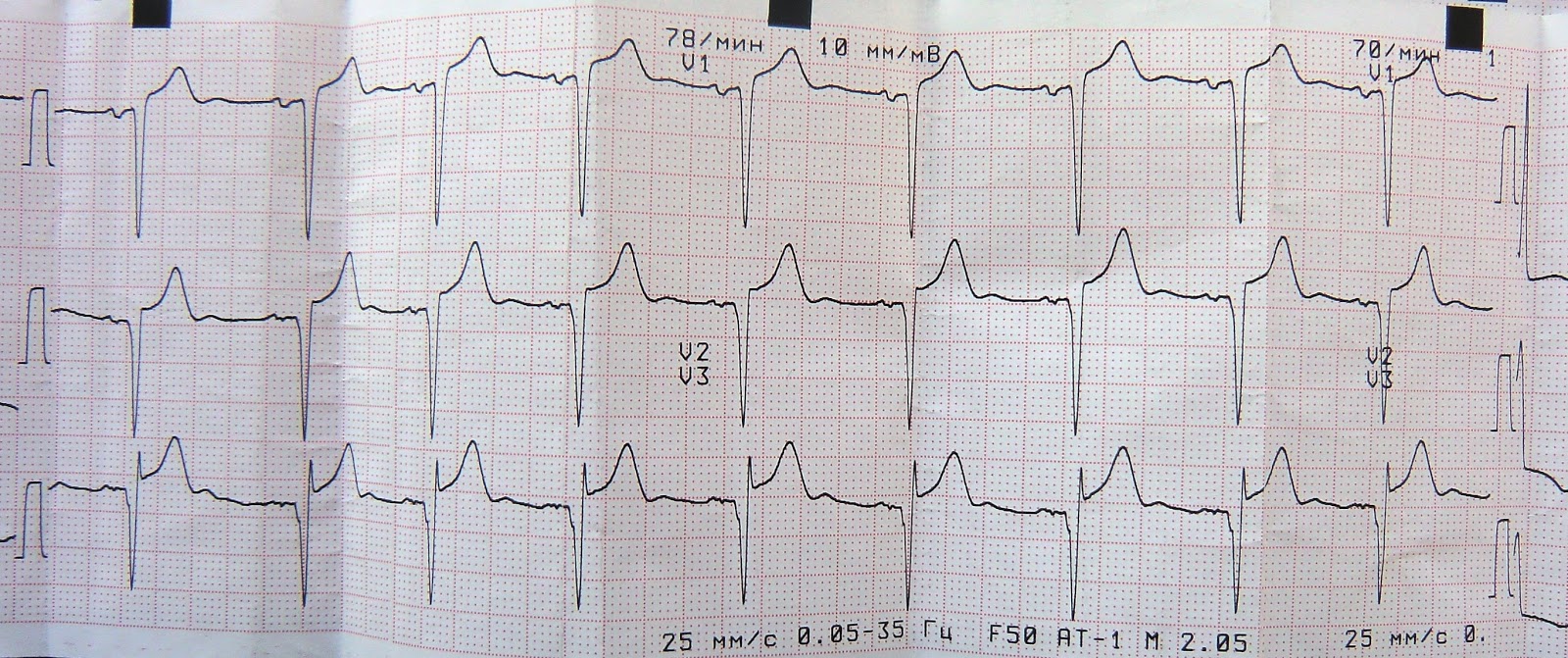 Экг при окс презентация