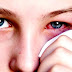Những lưu ý khi bị bệnh đau mắt đỏ