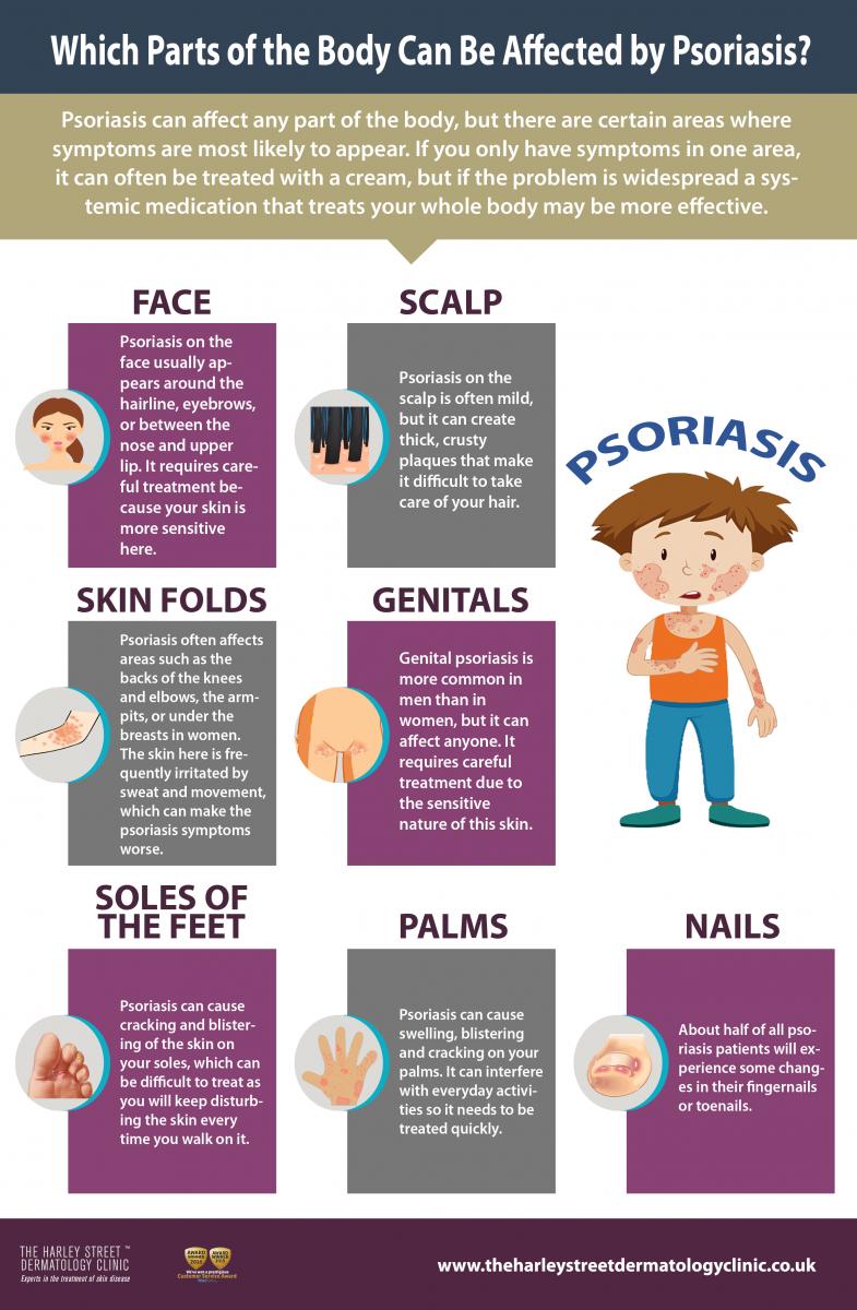 Psoriasis Help 4 Friends The difference between psoriasis and eczema