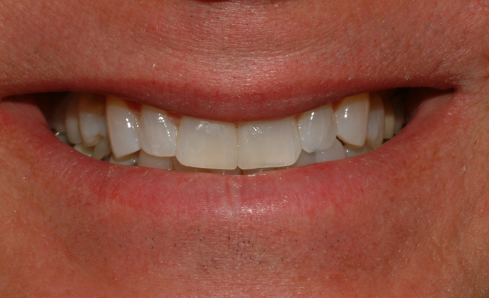 Dentistry on Dundas Whitening/Bonding Dental Makeover