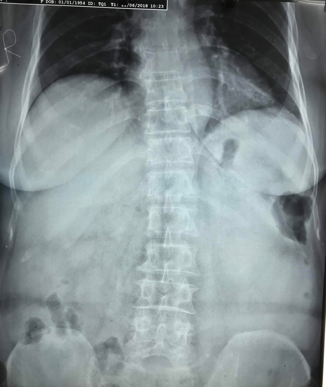 VIETNAMESE MEDIC ULTRASOUND CASE 500 BIG GIST TUMOR, Dr PHAN THANH