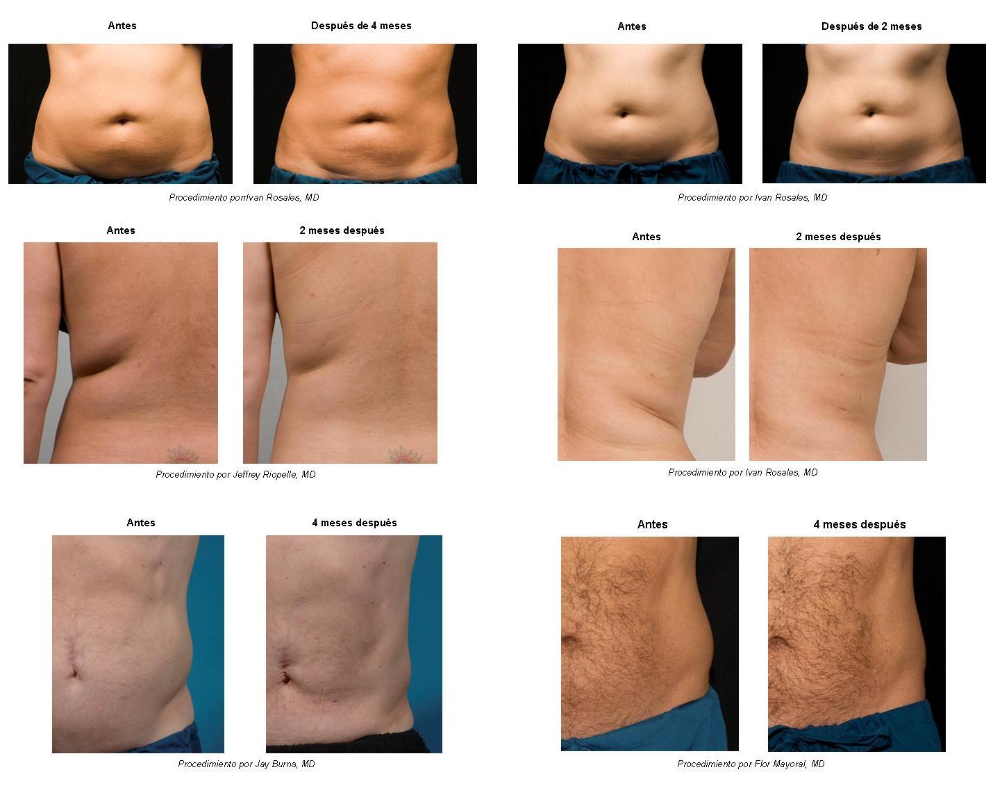 Criolipolisis opiniones