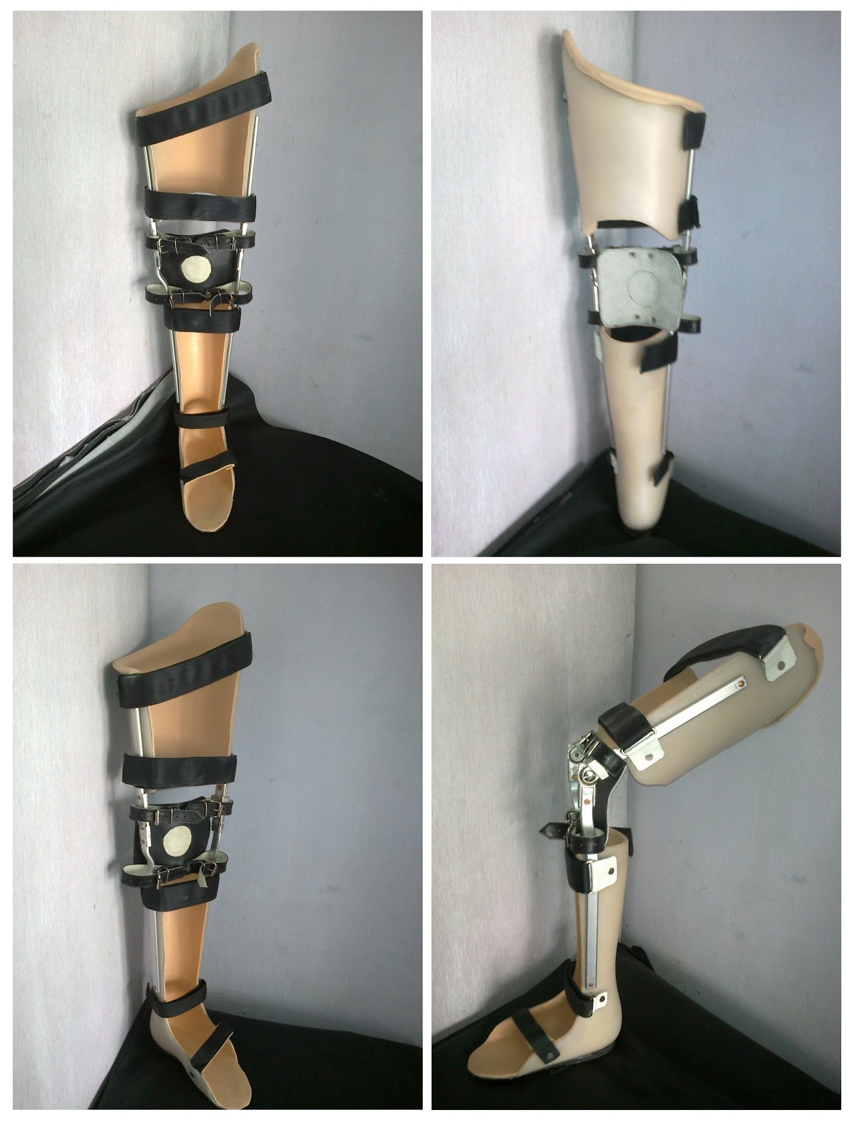 Custom Polio Brace (Knee Ankle Foot Orthosis)