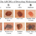 What Are Signs Of Skin Cancer?
