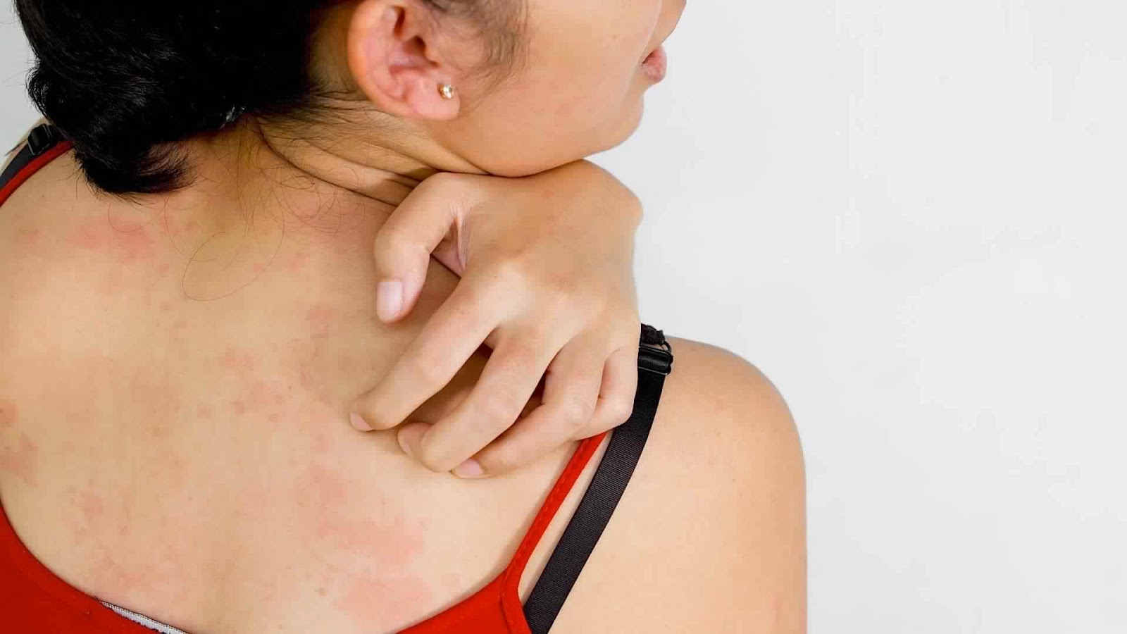 How To Cure Skin Rashes Naturally