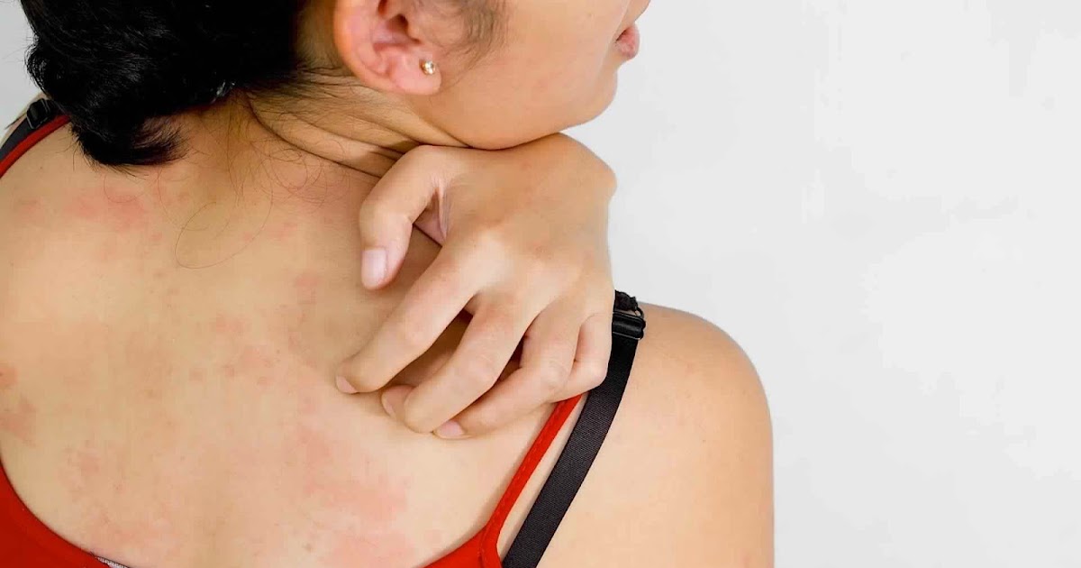 How To Cure Skin Rashes Naturally