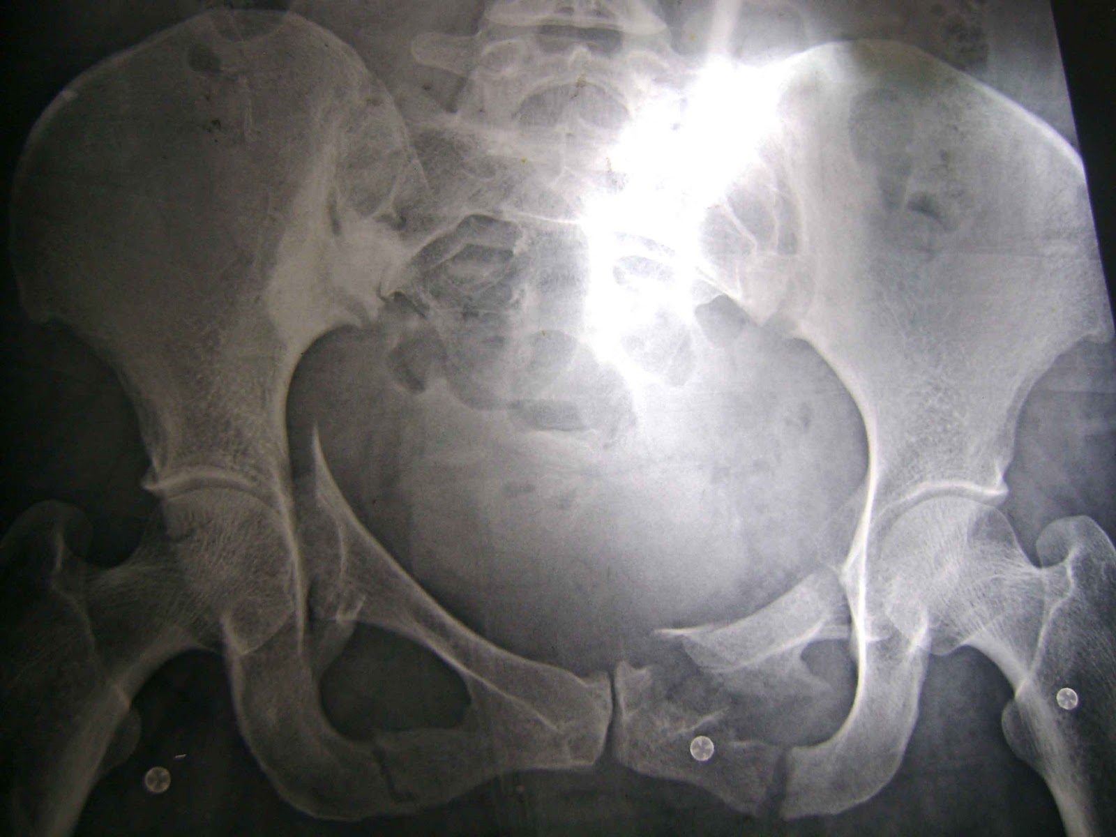 O R T O C R I T I C A: Cadera flotante expuesta en paciente con trauma