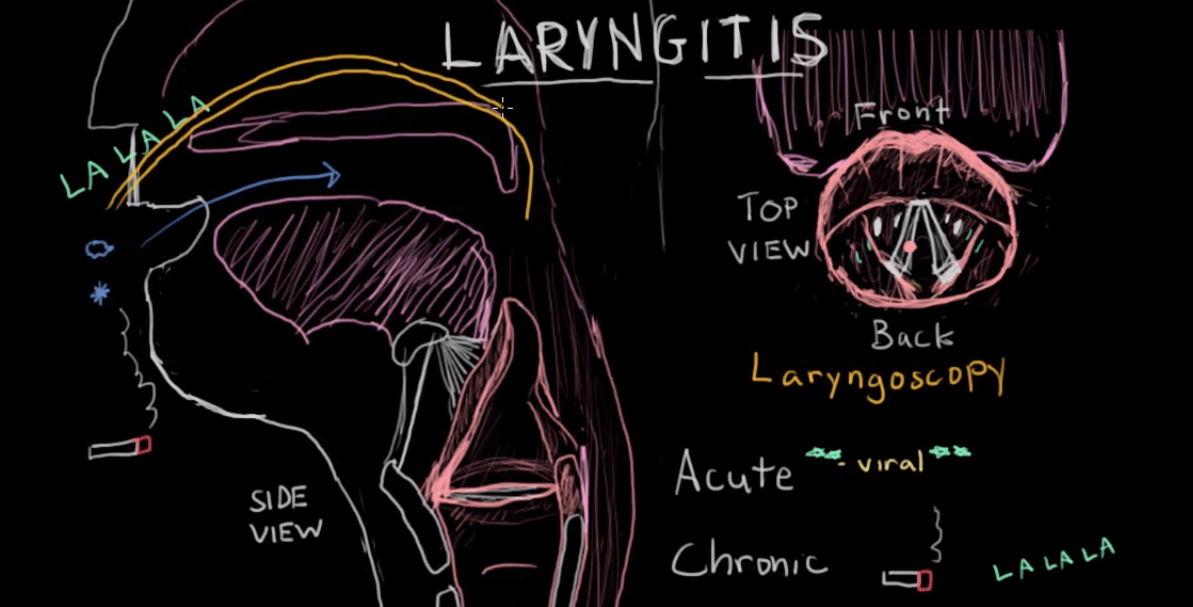 chronic-laryngitis