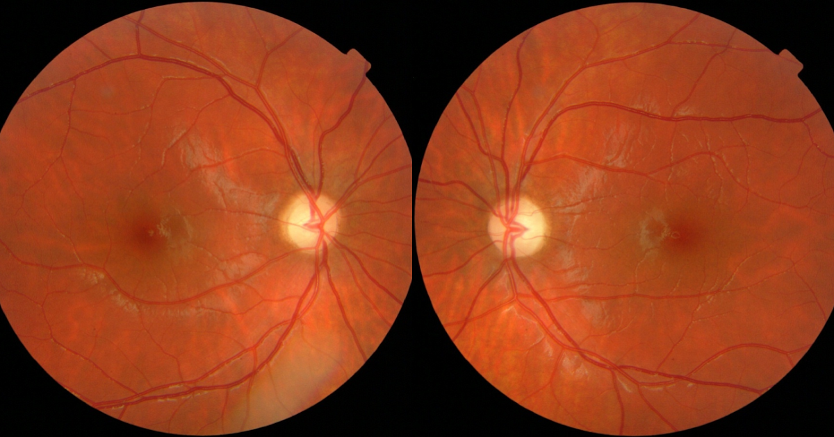 Foster Kennedy Syndrome Definition, Symptoms, Causes, Treatment