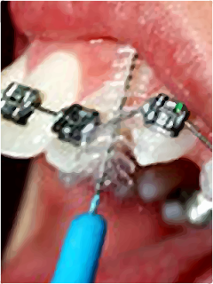 Best toothbrush for braces
