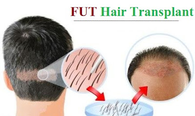 hair transplant kya hai, kaise kiya jata hai or kitne prakaar ka hota hai, fue hair transplant in hindi, fut hair transplant in hindi, hair weaving in hindi