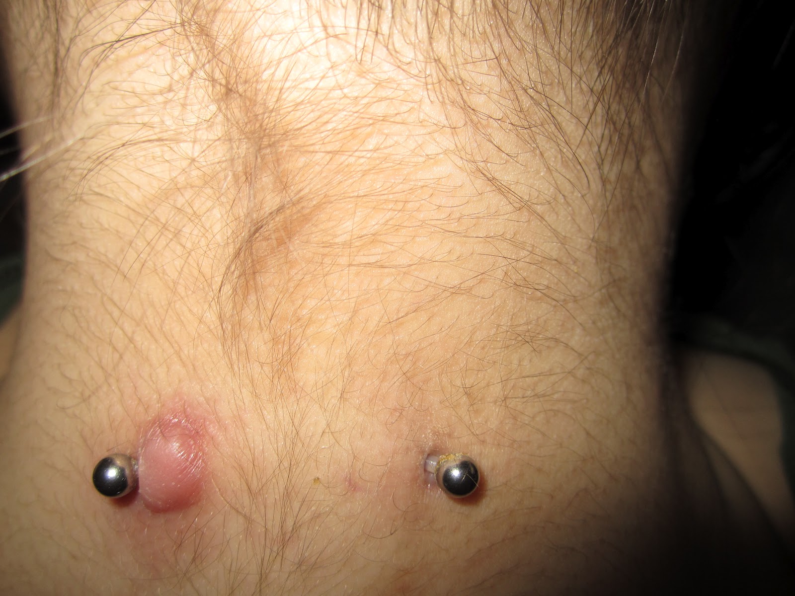 Keloid Scaring: Friday February 18, 2012 Day 1