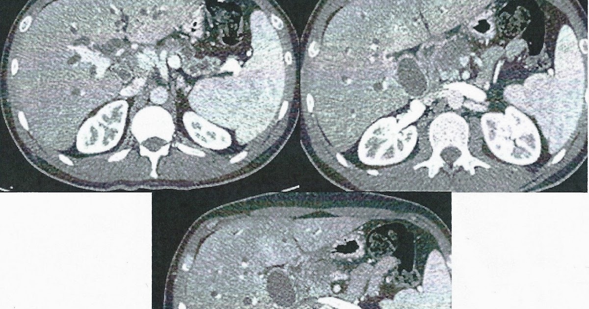 Colestasis en varón de 40 años MIR2014 Casos Clínicos