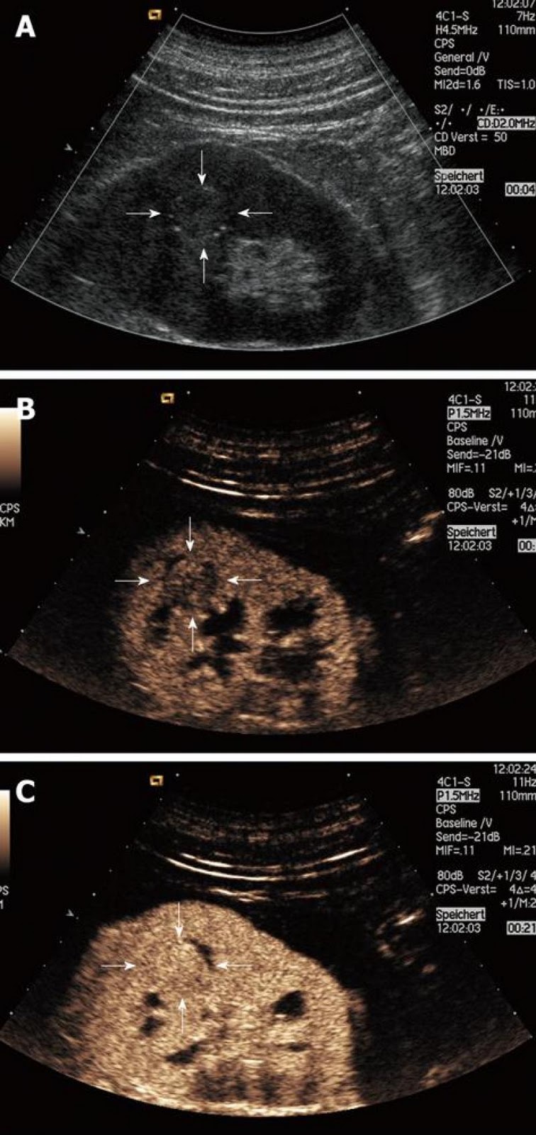 ABC Radiology Blog: Contrast-enhanced Ultrasound