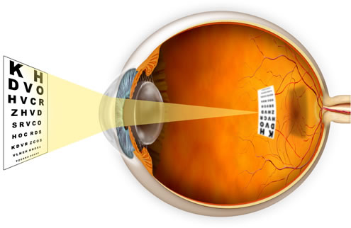 New analysis Shows shortsightedness is Prevented
