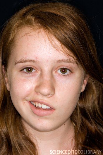 ♥ Felicia Fey ♥: Bell's Palsy