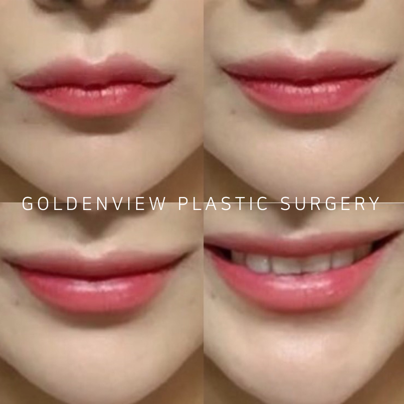 Goldenview Plastic surgery Lip lift korea plastic surgery /cosmetic