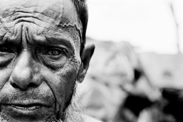 An undocumented Rohingya man who is blind in one eye stares into the camera lens.