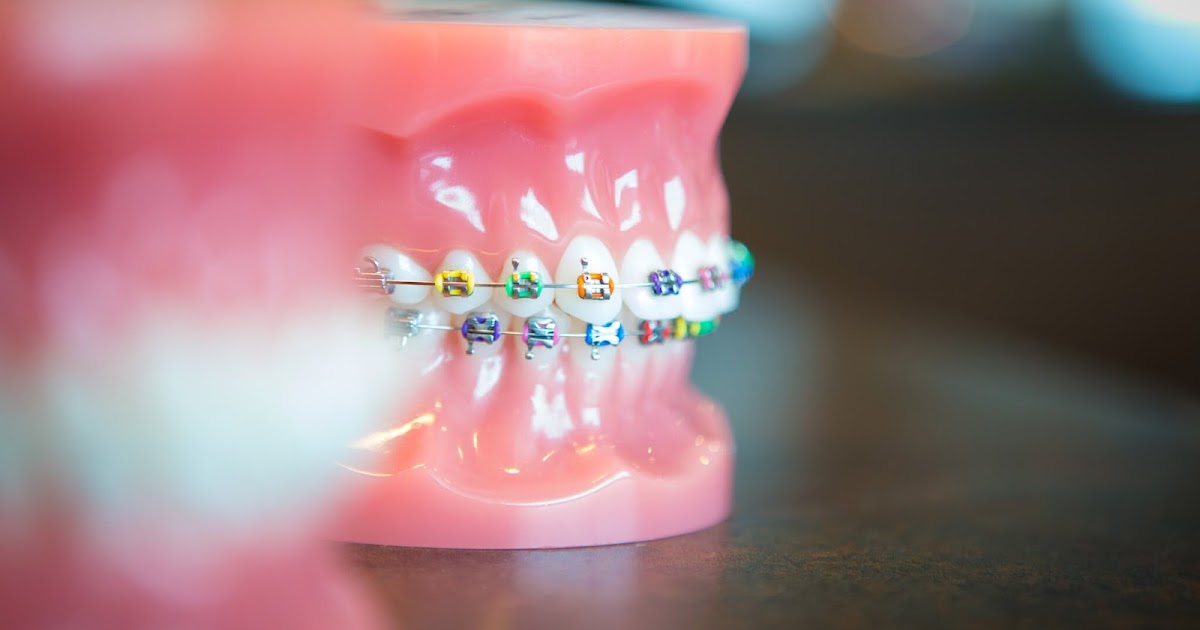 McClellan Orthodontics DIY Braces are Dangerous